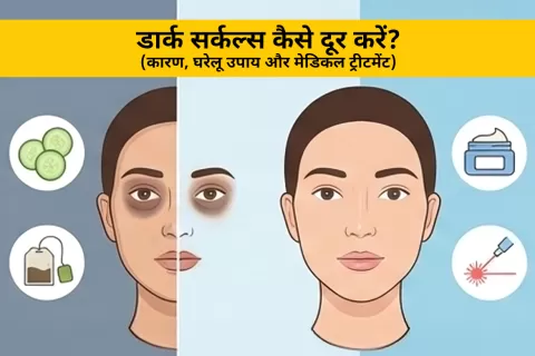 डार्क सर्कल्स कैसे दूर करें? कारण, उपचार और मेडिकल ट्रीटमेंट