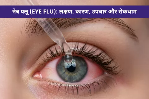 नेत्र फ्लू (Eye Flu): लक्षण, कारण, उपचार और रोकथाम
