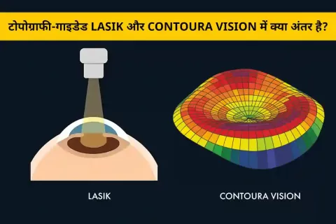 टोपोग्राफी-गाइडेड LASIK बनाम Contoura Vision: कौन है बेहतर विकल्प?