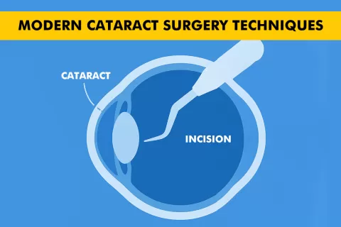 Modern Cataract Surgery Techniques: What Patients Should Know