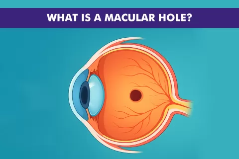 What Is a Macular Hole? Understanding the Basics