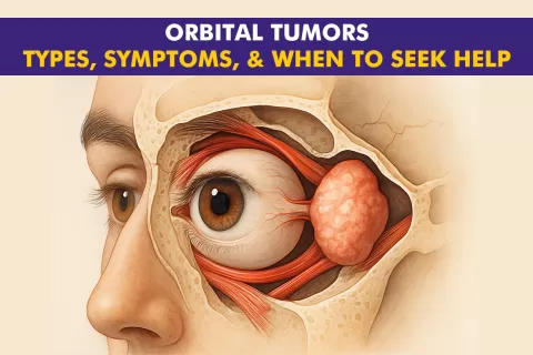 Orbital Tumors: Types, Symptoms, and When to Seek Help