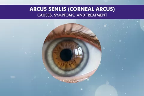Arcus Senilis: Causes, Diagnosis, and Treatment