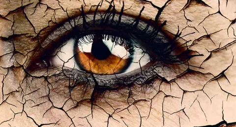 Dry Eyes: Causes, Symptoms, Treatment & Remedies