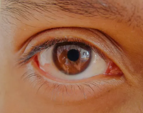 Iritis: Symptoms, Causes, Diagnosis and Treatment Options