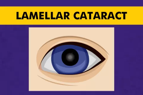 Lamellar Cataract (Zonular): Causes, Symptoms and Surgery