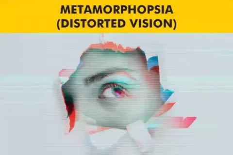 Metamorphopsia: Wavy Vision Causes, Tests, and Treatment