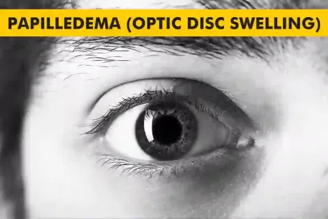 Papilledema (Optic Disc Swelling): Causes, Signs and Care