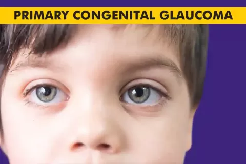 Congenital Glaucoma ? Causes, Symptoms, and Treatment