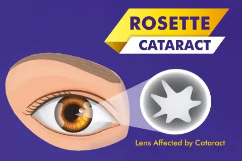 Rosette Cataract: Causes, Symptoms, and Treatment