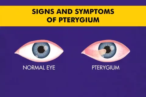 Pterygium Eye Condition: Causes, Symptoms, Stages & Treatment