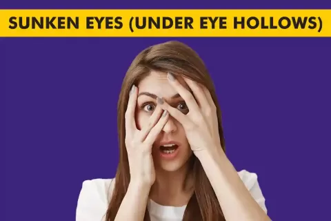 Sunken Eyes (Hollow Eyes): Causes, Symptoms & Treatment