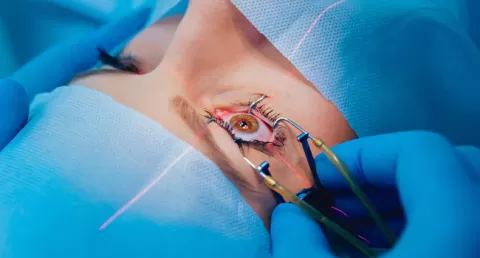 What to Expect Before and After LASIK Eye Surgery
