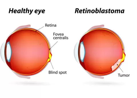 World Retinoblastoma Awareness