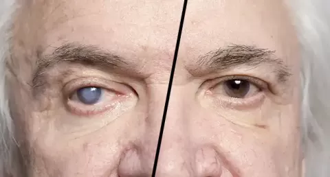 Everything You Need to Know About Cataract Surgery