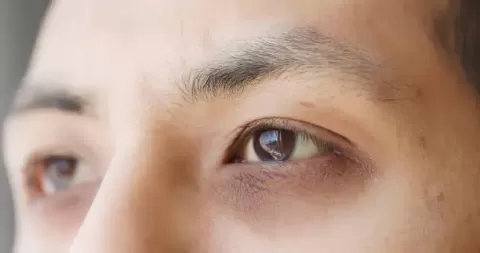 Dark Circles Under Eyes: Causes, Types and Best Treatments
