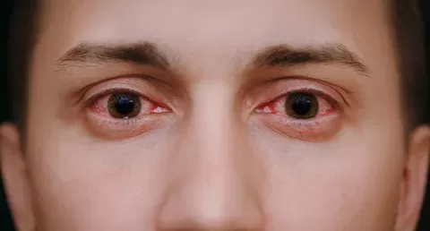 Why Eyes Turn Red After Swimming: Treatment & Prevention