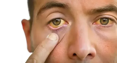 Yellow Eyes (Jaundice): Causes, Symptoms, & Treatment