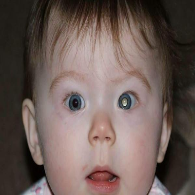 Bilateral retinoblastoma medical graphic