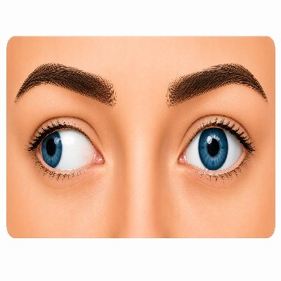 Exotropia - Outward turning of the eye