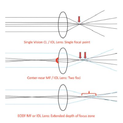 Extended Depth of Focus Lens