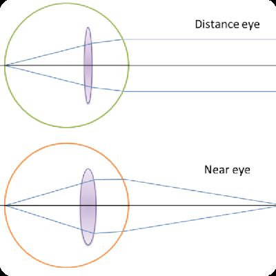 Monofocal Lens