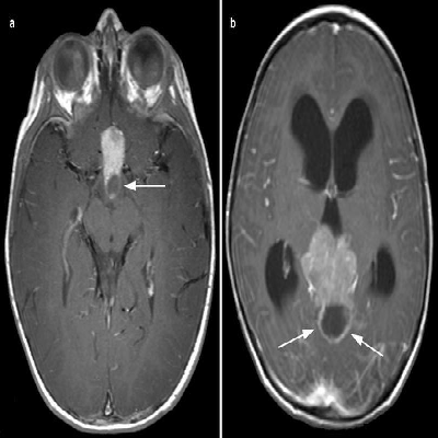 Trilateral retinoblastoma medical graphic